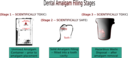 Dental Amalgam Filling Stages