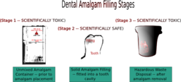 Dental Amalgam Filling Stages