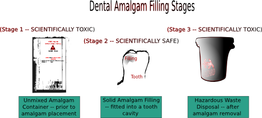 Dental Amalgam Filling Stages