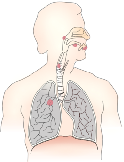 Cancer Caused By Smoking I