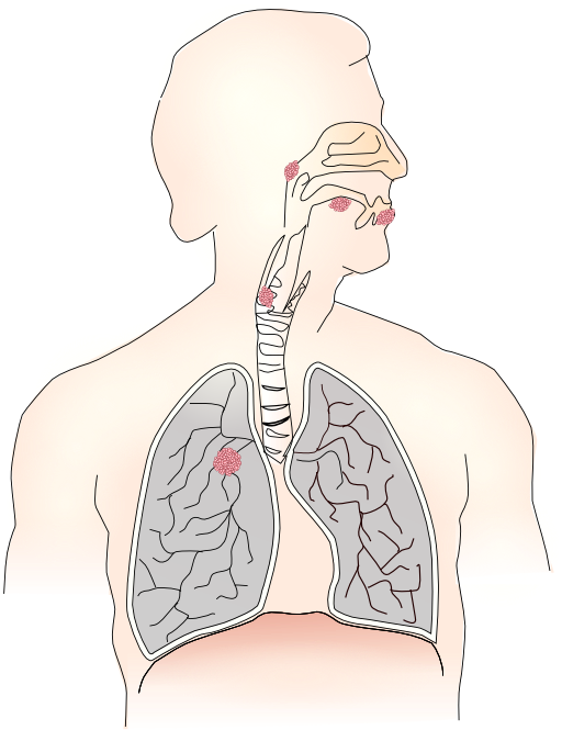 Cancer Caused By Smoking I